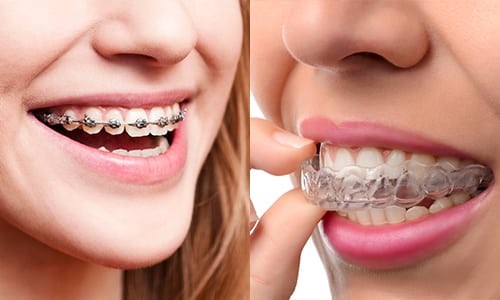Braces and Aligners